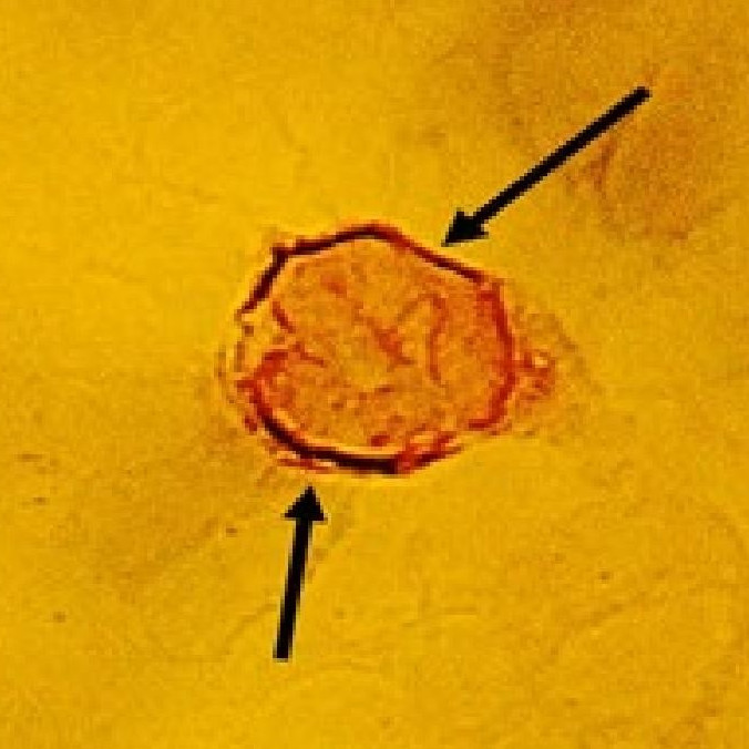 Two Borrelia Spirochetes Attached to Leukemic Lymphocyte