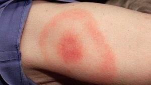 bullseye rash