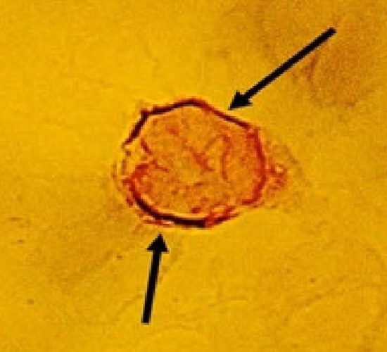 Two Borrelia Spirochetes Attached to Leukemic Lymphocyte