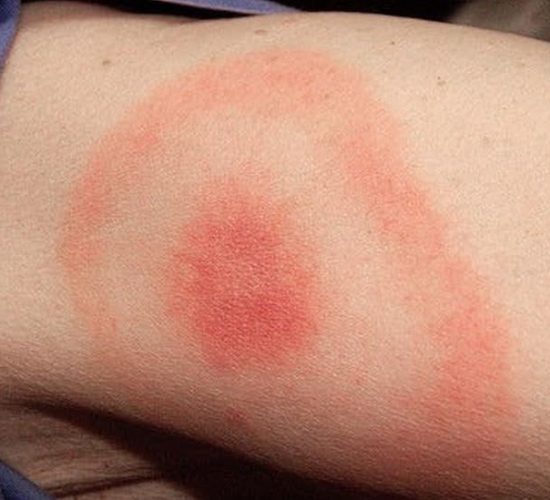 bullseye rash